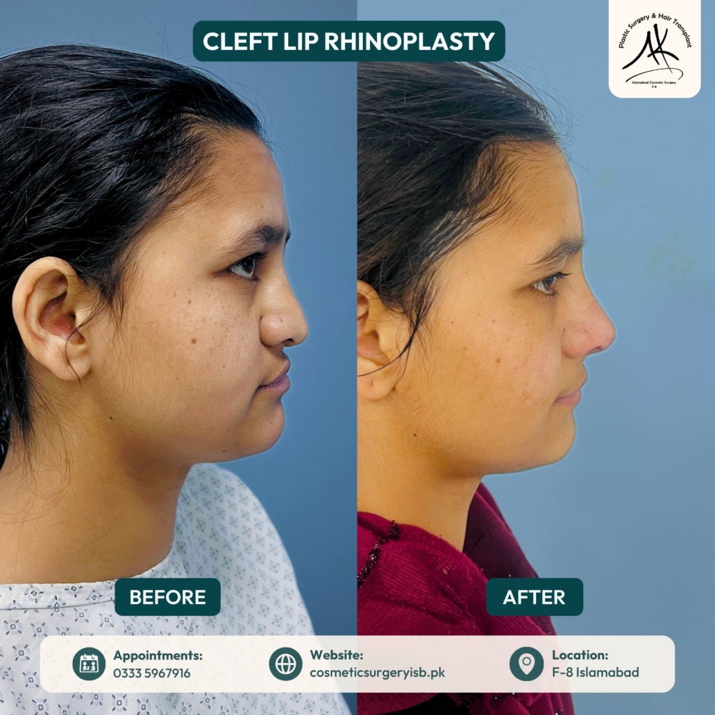 Rhinoplasty before and after Islamabad