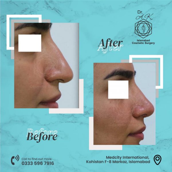 Nose reshaping before and after by Dr. Abdul Khaliq