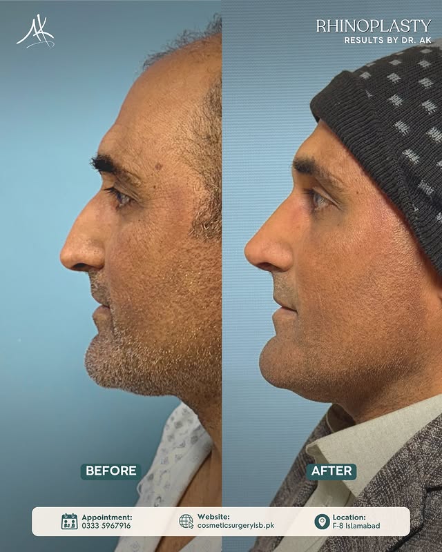 Rhinoplasty surgery results by top plastic surgeon in Islamabad